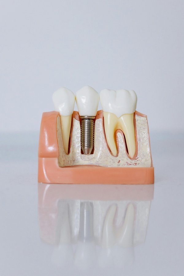 Implantologie dentaire à Genève : redécouvrez votre sourire